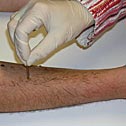 allergietest